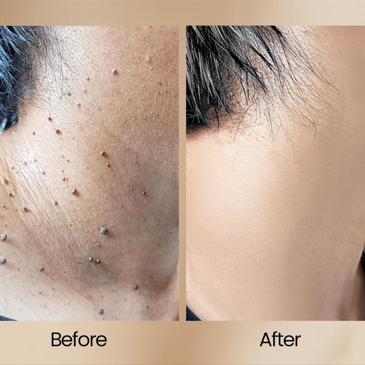 ClearSkinâą | Bienegift Vortborttagningsspray - Image 5