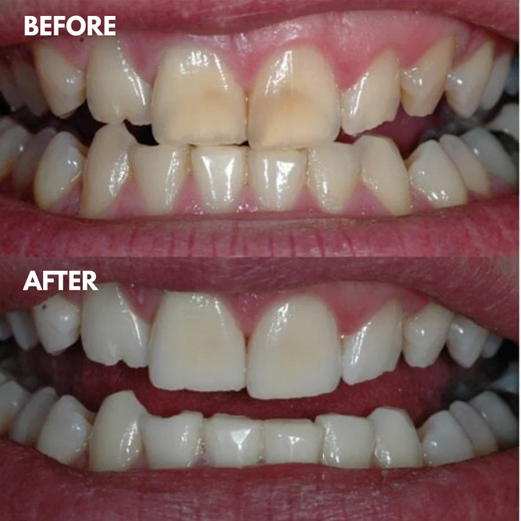1 + 1 GRATIS IDAG | LumaSmile™ - Image 2