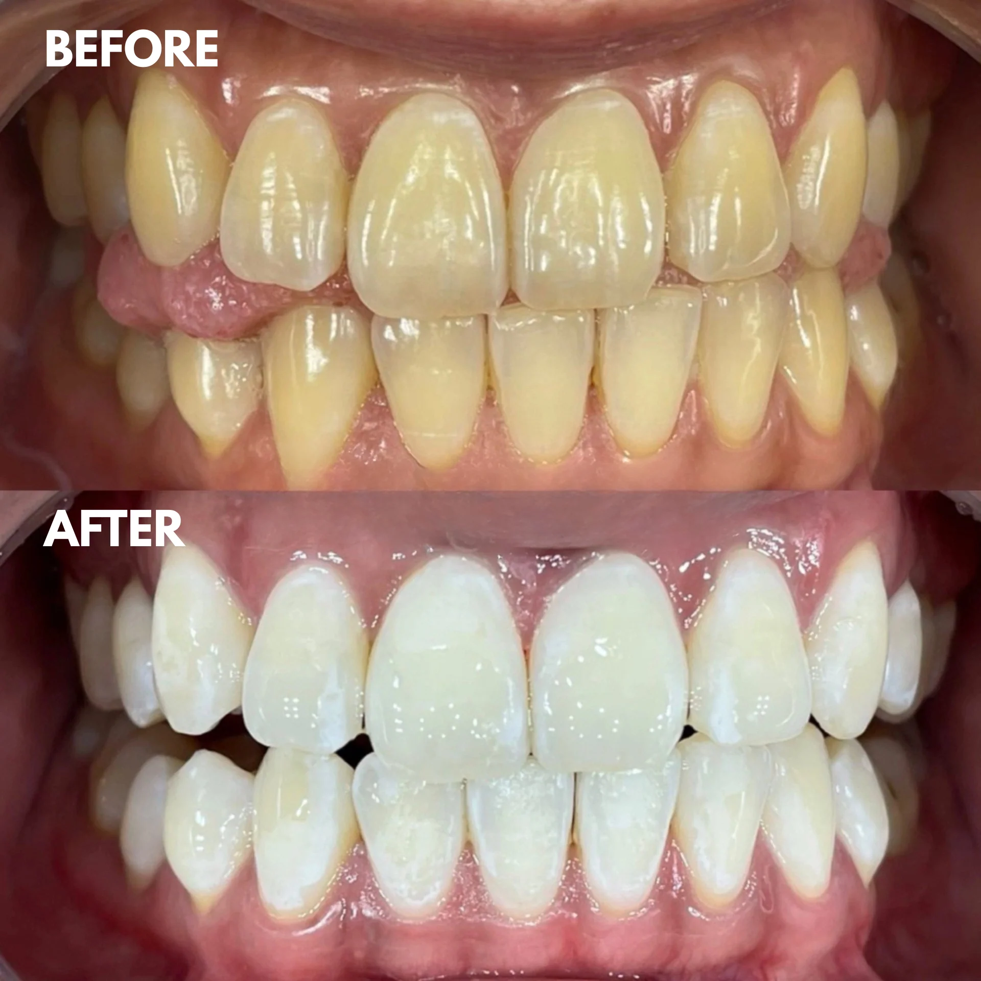 1 + 1 GRATIS IDAG | LumaSmile™ - Image 8