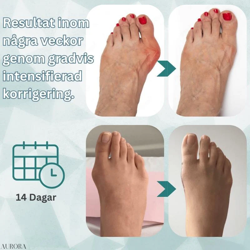 OrthoAlign™ – Korrigerare för snea tår | BEGRÄNSAD 50%-75% RABATT - Image 4