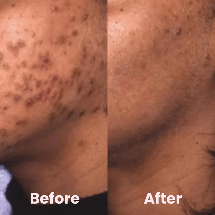 TILLFÄLLIGT 50% RABATT | RadiancePads™ | Pads med gurkmeja och kojisyra - Image 3